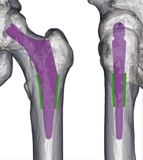 Reconstruction IRM mise en place prothèse de hanche