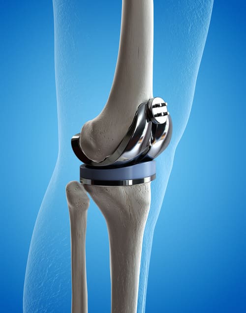 illustration 3 D prothèse de genou
