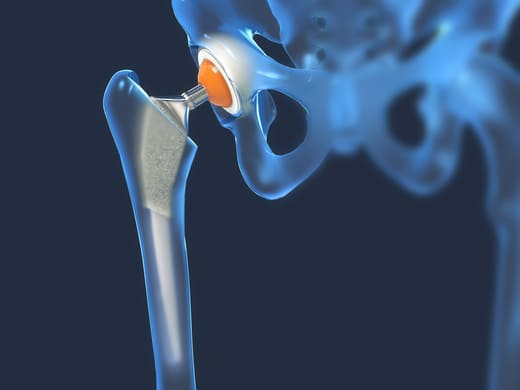 image 3D d'une prothèse de hanche