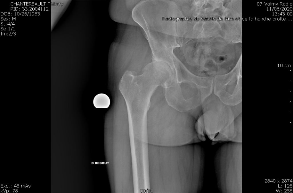 Radiographie nécrose de hanche